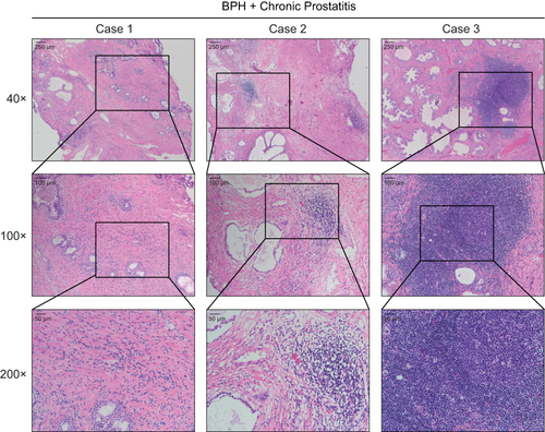 Figure 1 Hematoxylin-eosin (HE) staining showed the inflammatory cell infiltration to the prostate tissues. The prostate tissues were dissected from benign prostatic hypertrophy (BPH) patients who received surgical treatment, and accompanied with chronic prostatitis/chronic pelvic pain syndrome (CP/CPPS)-like symptoms. The lymphocytes and neutrophils were pointed out by the arrows.