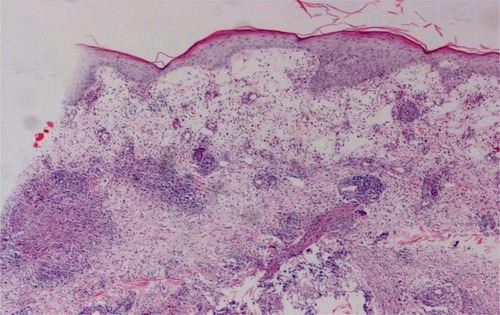 Figure 2 Pathological changes.Note: A neutrophilic and histiocytic granuloma (hematoxylin and eosin; original magnification ×400).