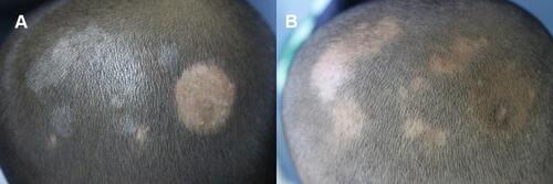 Figure 3 (A) Clinical manifestation of patient 3. (B) Complete remission after treatment of patient 3.