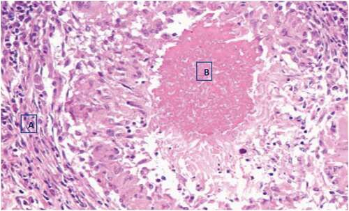 Figure 4. Histopathology of BTB suspected tuberculous lesioned lymph node with haemotoxylin-eosin (H&E) staining, X40 observation. A. lymphocytes, plasma cells, and monocytes. B. central caseous necrosis