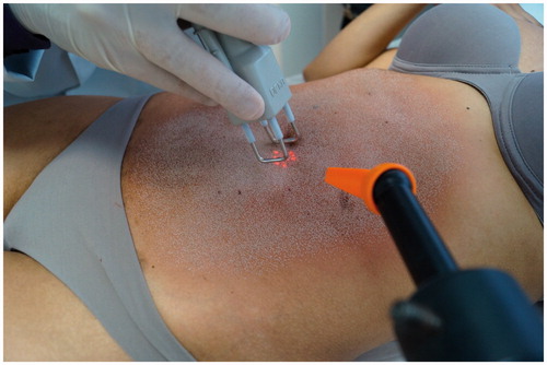 Figure 3. Treatment with fractional CO2 laser.