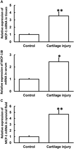 Figure 1. Relative expression of MCP-1 mRNA in cartilage tissues (A), serum (B) and synovial fluid (C) from patients with cartilage injury of elbow joint of upper limbs. Note: qRT-PCR was used to determine the expression of mRNA. GAPDH was used as internal reference, and expression of target gene in each group was divided by that of GAPDH. Then, the value of experimental group was normalized to control group. *p < 0.05 and **p < 0.01 compared with control group.