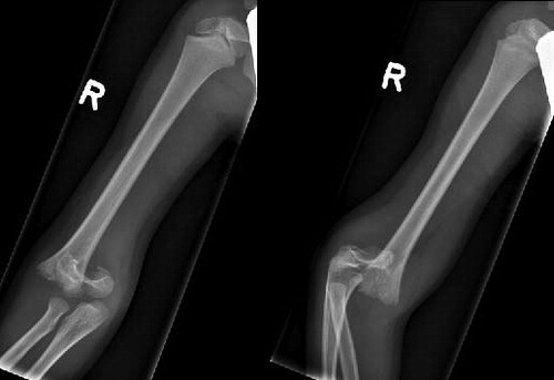 Figure 1. An isolated type-IV supracondylar humeral fracture in a 5-year-old boy.