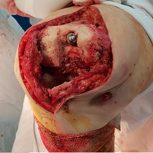 Figure 3 Intraoperative image after removal of the endoprosthesis components. An extensive T3 tibial defect by AORI and an F1 femoral defect by AORI are defined.