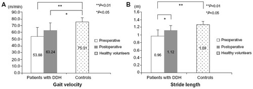 Figure 1 Temporospatial gait parameters of patients with DDH (pre- and postoperative) and controls.