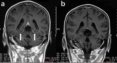 Figure 2 Gadolinium-enhanced coronal T1-weighted MRI of the brain. (a) Pre-treatment MRI showing pachymeningial thickening and enhancement along the cerebellar tentorium (arrows). (b) Post-treatment MRI showing improvement of thickness and reduced enhancement along the cerebellar tentorium.