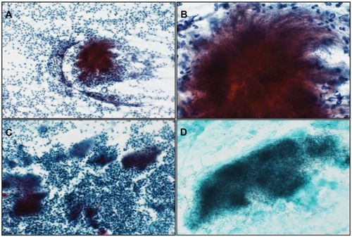 Figure 1 (A) Cytology of the endometrium, with basophilic granules of actinomyces seen with an inflammatory background (Papanicolaou stain, object lens magnification 10×). (B) Magnified image of (A) (Papanicolaou stain, 40×). Thin filamentous mycelia are seen spreading outwards. (C) Imprint cytology of intrauterine contraceptive device. Many actinomyces colonies are seen within severe inflammatory background (Papanicolaou stain, 10×). (D) Gomori methenamine-silver stain of (C) showing presence of numerous blackish fine mycelia (40×).