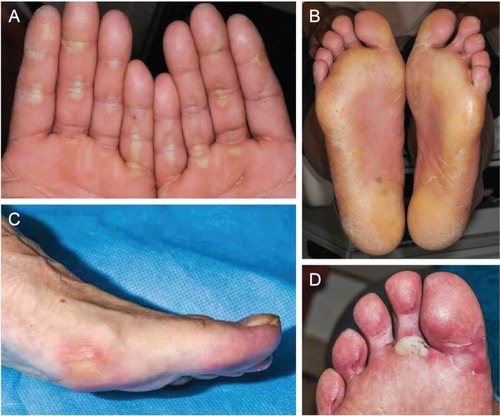 Figure 4 Examples of palmar–plantar erythrodysesthesia syndrome resulting from treatment with cabozantinib in patients with solid tumors.