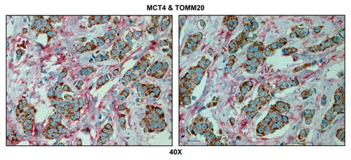 Figure 9 Visualizing the “reverse Warburg effect” by double labeling with MCT4 and TOMM20: Primary tumor tissue. Paraffin-embedded sections of human breast cancer primary tumors were immunostained with antibodies directed against MCT4 (red color) and TOMM20 (brown color). Slides were then counterstained with hematoxylin (blue color). Note that MCT4 staining is largely confined to the cancer-associated tumor stroma. In contrast, TOMM20 is specifically associated with the epithelial breast cancer cells. Two representative images are shown. Original magnification, 40x.