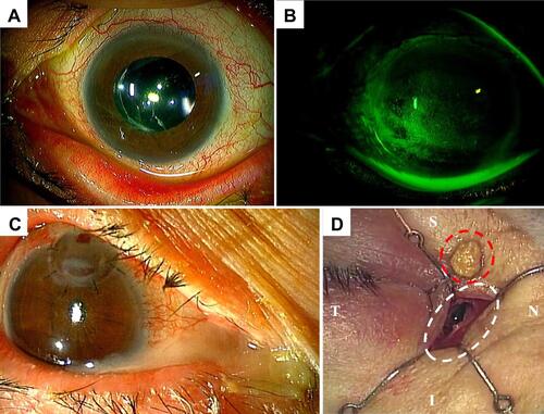 Figure 2 The cornea of the other eye and lacrimal disease in the perforated eye. (A and B) Slit lamp photographs of the left eye in case 6 at the time of initial examination. Although no peripheral thinning or perforation of the cornea is evident, severe SPK is observed with fluorescent staining, indicating the presence of dry eye. (C) Slit lamp photograph of the right eye in case 6 on hospital day 13. Backflow of purulent discharge from the lacrimal duct is evident. (D) Intraoperative photograph of the right eye in case 6 on hospital day 15. Percutaneous dacryocystectomy (white dotted circle) and closure of the lacrimal puncta and lacrimal canaliculi are performed. Intraoperatively, a large lacrimal concretion (red dotted circle) is detected in the lacrimal sac and extracted. The concretion consists of MSSA and suspected fungus.