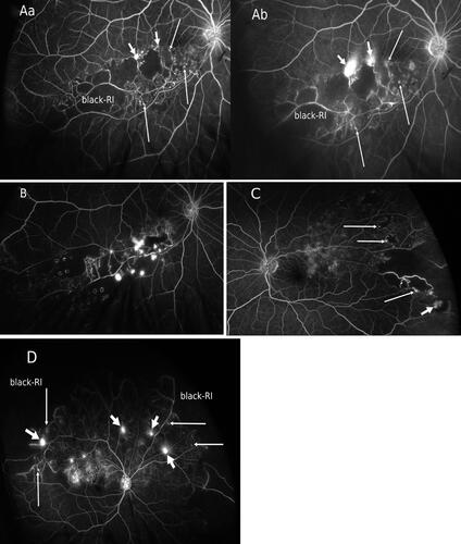 Figure 2 Retinal neovascularizations and angiographic pattern. All the figures (A–D) here are ultra-widefield fluorescein angiograms (UWF-FA) of different patients who had sustained branch retinal vein occlusions. The UWF-FAs depict a recurring theme of angiographic pattern (3Bs pattern); presence of black retinal ischemia (black-RI), budding of retinal microvascular anomalies (RMAs) originating from the same watershed border of black-RI as retinal neovascularizations (NVEs). (A) (a–b) are UWF-FA phases of a patient showing the sectorial black-RI located in the inferotemporal retina involving inferior macula. Active NVEs are seen as hyperfluorescent spots (short arrows) at early phase of angiogram (2Aa) and classically leak fluorescence profusely at the late phase of angiogram (2Ab). The NVEs arise from the water-shed border of black-RI and in this case, are within the macula region. UWF-FA also depicts numerous tiny hyperfluorescent dots of RMAs (long arrows) in early phase of angiogram (2Aa) at the water-shed border but unlike NVEs, they do not leak profusely at late phase (2Ab). (B) UWF-FA of a different patient with branch retinal vein occlusion, showing residual black-RI from insufficient laser treatment hence leading to the proliferation of NVEs with localized pre-retinal hemorrhage in the inferior macula. Note numerous active NVEs arise from the border of the water-shed border, some arise along the venous border within the black-RI. (C) UWF-FA shows patchy ischemic changes in posterior pole but black-RI is most prominent in the far peripheral retina with numerous sprouting NVEs and RMAs (tiny hyperfluorescent dots, long arrows) at the water-shed border. The largest NVE (short arrow) has already bled with localized pre-retinal hemorrhage. (D) UWF-FA of a patient with superior hemi-retinal vein occlusion. The UWF-FA depicts extensive retina ischemia in the superior hemisphere of retina, the black-RI is most prominent at the far peripheral retina. Numerous active NVEs (short arrows) arise from the watershed border and along venous border within the black-RI. RMAs are seen as fainter tiny fluorescein dots (long arrows) scattered along the water-shed border and within the black-RI.
