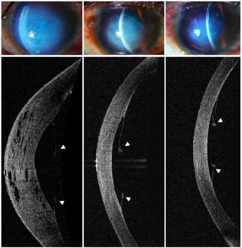 Figure 2 Slit-lamp and anterior segment optical coherence tomographic images of the right eye of a 16-year-old boy with atopy, vernal keratoconjunctivitis, and advanced keratoconus who presented with acute corneal hydrops after an episode of severe eye-rubbing. Corneal edema decreased gradually from presentation (left panel, day 18 after onset of corneal hydrops) to 2 months (middle panel) and 4 months (right panel) thereafter. The patient was treated conservatively with topical steroids and hyperosmotic eye drops. The break and persistent detachment of the Descemet’s membrane (white arrowheads) is clearly discernible on anterior segment optical coherence tomographic imaging.