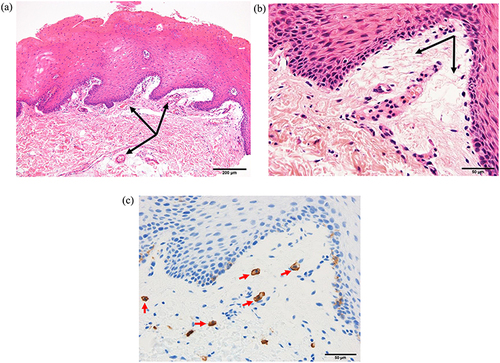 Figure 1 Buccal mucosal pathology after challenge testing. We biopsied our patient’s buccal mucosa immediately after intraoral bleeding developed due to her ingestion of potato snacks. Hematoxylin and eosin staining shows telangiectasia (black arrows) (a) and edema (black arrows) (b) of the subepithelial submucosa. Immunohistochemistry for c-kit reveals mast cells (red arrows) (c). The images in panels (b and c) are of the same section.
