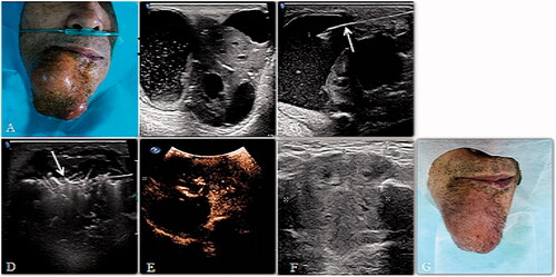 Figure 3. (A, B) A 69-year-old man had a primary SCC on the right mentum region. An irregularly shaped tumor could be seen and the lesion consisted of cystic and solid parts. (C) Aspirating the fluid in the lesion with a fine needle (arrow). (D) After aspiration, an microwave atenna (arrow) was placed in the lesion to ablate the solid portion. (E) After MWA, CEUS showed that most of the tumor was inactivated and showed no enhancement. (F, G) Sonogram of the lesion 4 months after MWA, the tumor shrank visibly.