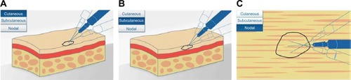 Figure 3 Diagram showing intralesional injection of talimogene laherparepvec into (A) cutaneous, (B) subcutaneous, and (C) nodal lesions. Copyright of Amgen Inc., reproduced with permission.Citation22