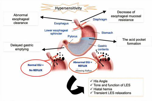 Figure 1 The complex pathogenesis of GERD.