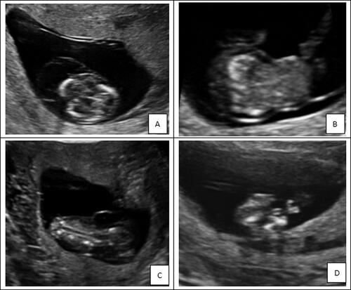 Figure 3. The ultrasound examination of the case with diastrophic dysplasia. The ultrasound examination showed that cystic hygroma (A), omphalocele (B), spinal malformation (C) and short limbs (D).