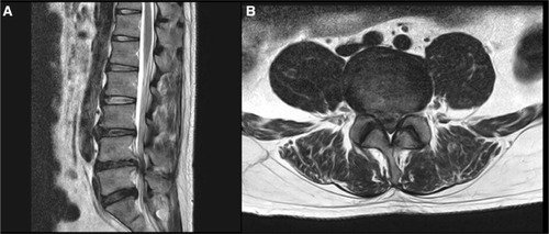 Figure 2 Magnetic resonance T2-weighted imaging of the lumbosacral spine.