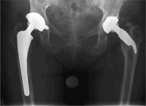 Figure 3. Standard anteroposterior radiograph of the pelvis with marked horizontal migration of CUT prosthesis with complete resection of the femoral neck 5.1 years postoperatively. The patient complained of slight pain (pain score 40 points by HHS) without any correlation with the radiographical finding. Regular position of right-sided cementless total hip replacement with standard stem.