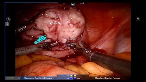 Figure 4 Fibroid enucleation with the assistance of robotic tenaculum using blunt dissection in conjunction with the use of harmonic energy as needed.