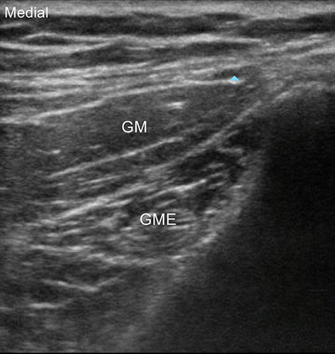 Figure 2 The short-axis views of the medial branch of the SCN. Blue arrow denotes medial branch of the SCN.