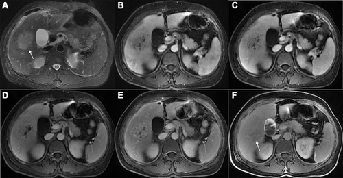 Figure 2 A 52-year-old woman with an atypical hepatic abscess. (A) The T2-weighted imaging shows a well-defined hyperintense lesion (arrow) in segment V. (B) In the early AP, the conspicuity score of the fuzzy lesion was 3. (C–E) In the late AP (C), PVP (D), and TP (E), the lesion had clearer boundaries (rating 4). (F) The HBPI obtained 90 min after injection of the contrast agent shows an ill-defined lesion (arrow, rating 2); it was regarded as having a conspicuity discrepancy.