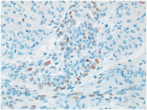 Figure 6. Estrogen receptor (ER) staining shows limited zones with some nuclear staining. Positive in 27% of PEComa’s.
