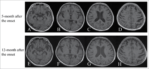 Figure 2. T1-weighted MRI 5 months and 12 months after onset. Panel A-(H)show serial T1-weighted MR images. Serial T1-weighted MR images at 5 months (upper lane, panels A-D) and 12 months (lower lane, panels E-H) after onset showed gradually progressing frontotemporal cortical atrophy, predominantly in the temporal lobes.