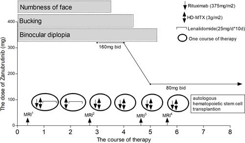 Figure 2 Treatment procedure, and timeline of symptoms during the treatment. MRI1, first MRI scan; MRI2, second MRI scan; MRI3, third MRI scan; MRI4, fourth MRI scan; bid, twice daily.