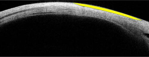 Figure 3 Well defined anterior ocular coat contour (yellow arc).