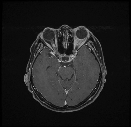 Figure 3 Gadolinium contrast-enhanced T1-weighted magnetic resonance imaging with fat suppression demonstrating a small right optic nerve sheath meningioma postradiotherapy that has remained clinically and radiologically stable. Incomplete fat suppression artifact is present in the left orbit.
