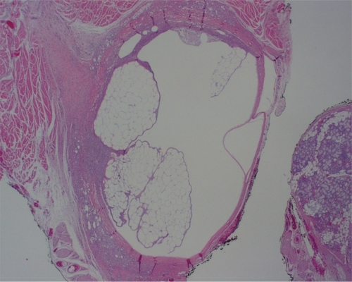 Figure 1 Low power view of biopsy specimen from lower lip from a 74-year-old woman who presented with a submucosal nodule of the lower lip. The patient had received injections of Restylane to the lips approximately 6 months before. Histologic examination of the biopsied specimen revealed the presence of multiple vacuolated, cyst-like areas. These are surrounded by a fibrotic connective tissue capsule and a tissue reaction composed predominantly of histiocytes and foamy macrophages. (Hematoxylin and eosin, original magnification 10×).