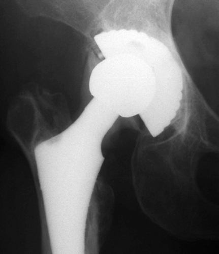 Figure 1. Anteroposterior radiograph taken 25 months after revision because of ceramic liner fracture, demonstrating metallosis around the stem neck. Note the loss of the superior part of the cobalt-chromium head.