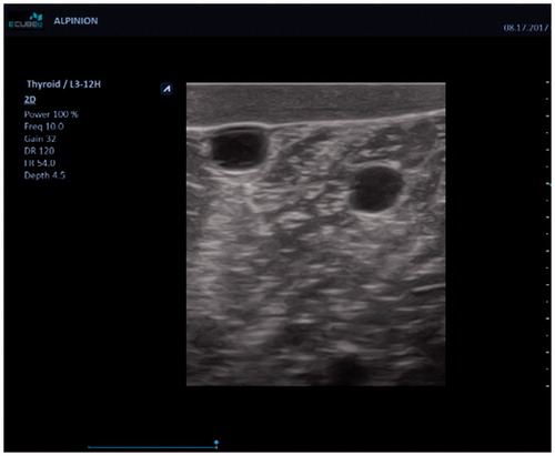 Figure 3. Ultrasound image obtained from the breast phantom.