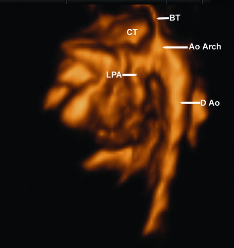 Figure 5.  B-flow imaging displaying the common truncus (CT) and some of its branches, including the aortic arch (Ao Arch) and the left pulmonary artery (LPA); the image is seen from the left. D Ao, descending aorta, BT, brachiocephalic trunk.