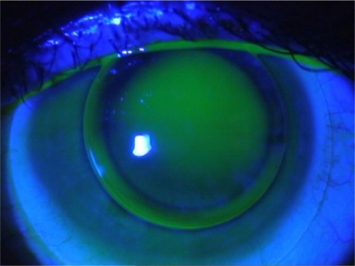 Figure 2 Fluorescein pattern of optimal piggyback contact lens fitting.