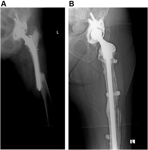 Figure 2 Preoperative anteroposterior radiograph of a Vancouver type B1 periprosthetic femoral fracture in a 77-year-old female (A) treated with a long cemented femoral stem (B). At 5 years of follow-up, the fracture was healed and the stem did not show any sign of aseptic loosening.