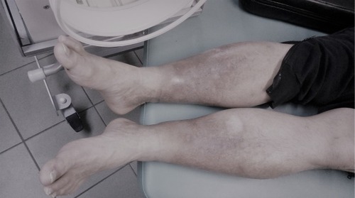 Figure 3 Local status of both the legs after the end of therapeutic cycle with the use of the device Laserobaria-S.