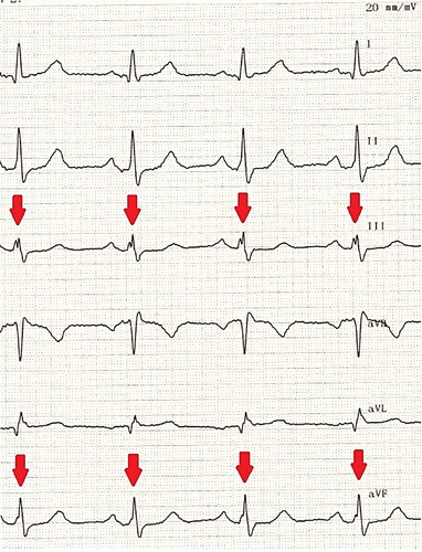 Figure 1. Twelve-Lead ECG of a patient with fQRS on ECG. There are fQRS complexes in lead DIII and aVF (arrowheads).