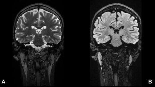 Figure 2 Mesial temporal sclerosis. Coronal brain MRI T2 sequence (A) and FLAIR sequence (B) showing left hippocampal atrophy and high signal intensity.