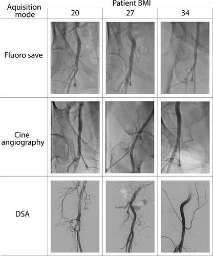 Figure 5 Examples of images of the common femoral artery using fluoro save, cine angiography and digital subtraction angiography (DSA) in patients of differing body mass index (BMI).