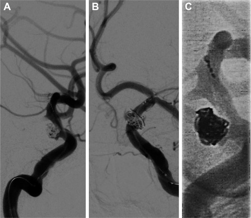 Figure 3 Head DSA images showing delivery of a Solitaire AB stent to the distal bifurcation of the left internal carotid artery.