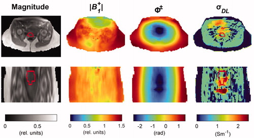 Figure 2. DL-EPT. Transverse and coronal cross-section of MR magnitude image from AFI sequence, |B1+| map, transceive phase (ϕ±) map, conductivity map obtained with DL-EPT (σDL). |B1+| and ϕ± maps are given as input to the trained network, which infers σDL. The tumor contour is shown in red. The tumor was delineated by a radiation oncologist on an ADC map (part of the diagnostic MRI protocol) [Citation85,Citation86]. The tumor delineation was then rigidly transferred to the frame of reference of the AFI image.