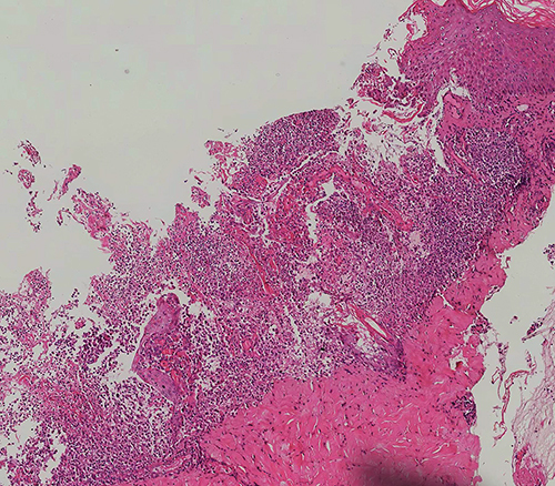 Figure 2 Histopathology of the skin lesion: Excessive keratinization, thickening of the spinous layer, and a significant infiltration of dense neutrophils in a band-like pattern in the superficial to mid-dermis (HEx100).