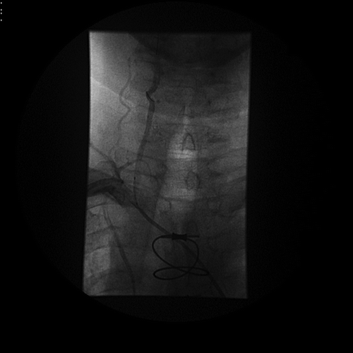 Figure 2 Vertebral angiogram showing the Boston Scientific FilterWire deployed and the Taxus stent being positioned before deployment.