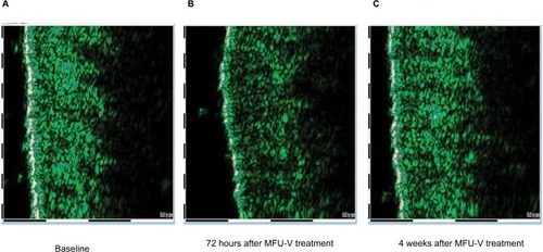 Figure 3 Course of edema: (A) before MFU-V, (B) edema at 72 hours after MFU-V, and (C) resolution of edema.