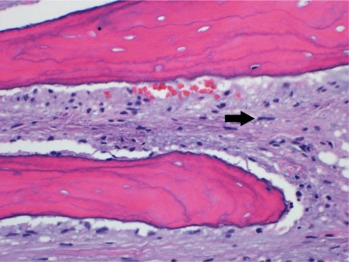 Figure 4 Distal femur biopsy photomicrograph.