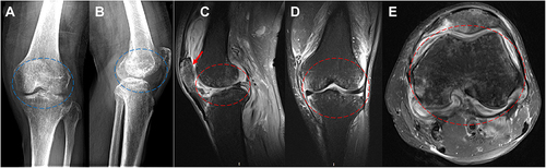 Figure 1 On admission to the hospital, X-ray and MRI images were taken of the left knee joint. (A and B) An X-ray of the distal femur and the proximal tibia revealed patches of osteopenia (blue circle). (C–E) There was a synovial infection in the knee joint, a localized full-thickness defect in the patellar cartilage (red arrow), and a diffuse patchy signal in the bone marrow on T2-weighted imaging (red circle).