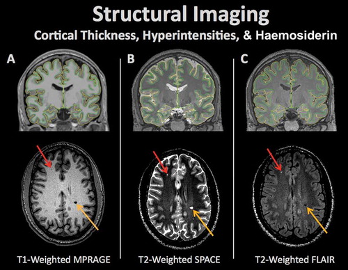 Figure 1. Structural brain imaging refers to a set of procedures for measuring a variety of morphometric properties of the brain. Alterations in brain structure in individuals or groups of individuals may be linked to pathologic processes. Different types of imaging contrasts measure various aspects of brain structure including (A) T1-weighted (typically used for differentiation of gray and white matter and cortical surface modeling), (B) T2-weighted (typically used to detect tissue pathology with increased fluid content), and (C) Fluid attenuated inversion recovery (FLAIR; typically used to measure pathology including stroke). The pial and white matter surfaces are outlined in yellow and green, respectively, capturing the thickness of the cortex. Aberrations in each scan can represent neural abnormalities such as white matter lesions (red arrow) or hemosiderins (orange arrow).