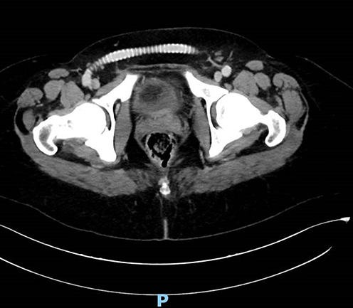 Figure 1 After removal of the kidney graft, that was found detached from the iliac artery due to Aspergillus fungal infestation repetitive vascular surgery was performed with Gore-Tex anastomosis created between both femoral arteries to repair leg ischemia (demonstrated by the computerized tomography).